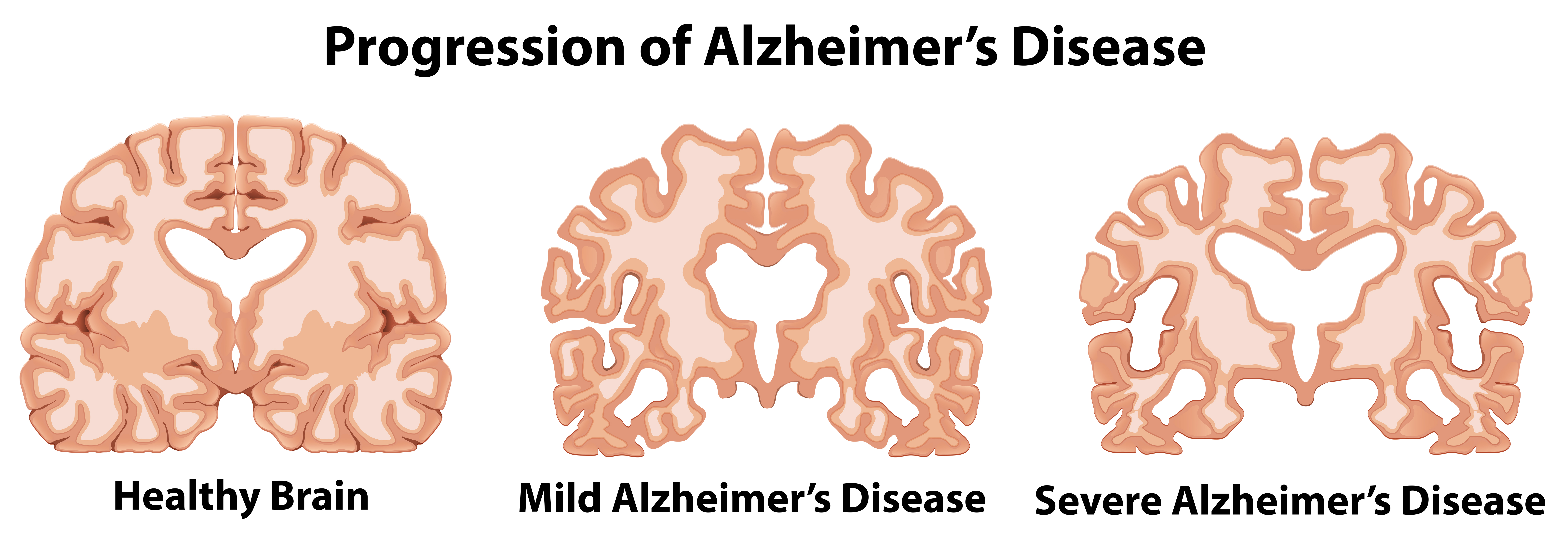 Progres Alzheimer/ freepik