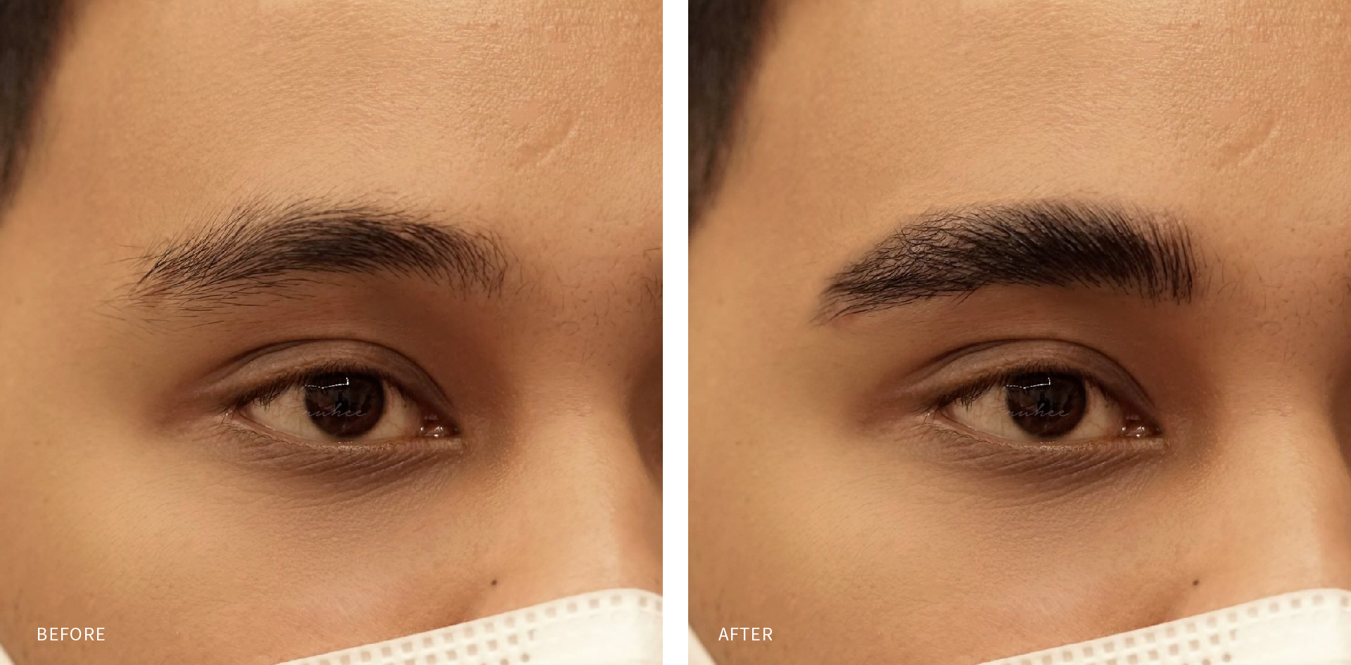 Ilustrasi hasil brow lift (Dok. Ruhee)