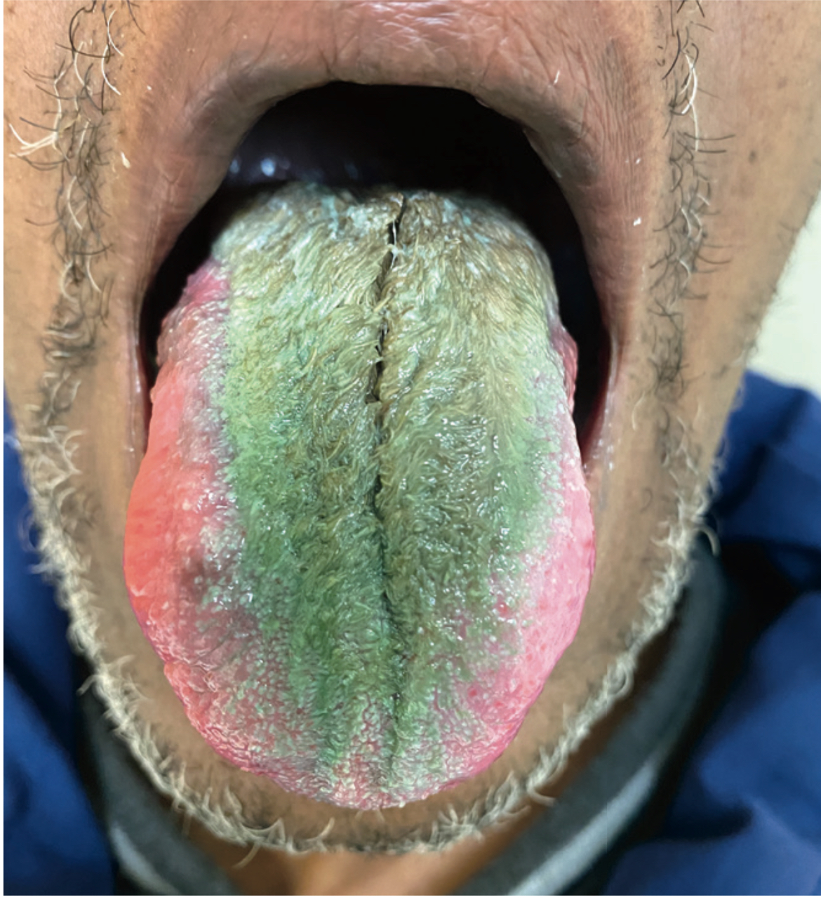 Kondisi lidah berbulu. (Sumber gambar : NEJM)